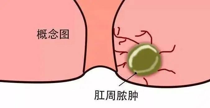 济南肛泰肛肠医院：为什么患上肛周脓肿要及时治疗？