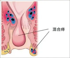 济南肛泰肛肠医院：混合痔治疗/混合痔的诱因及其危害有哪些？