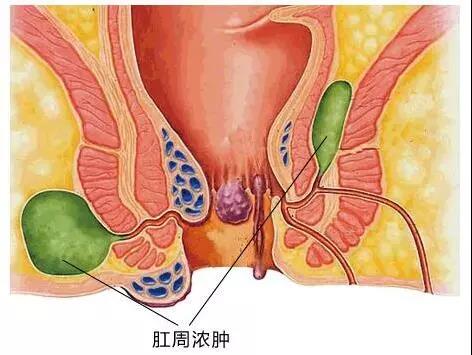 济南肛泰肛肠医院：想让屁股少遭罪，肛周脓肿你必须了解！