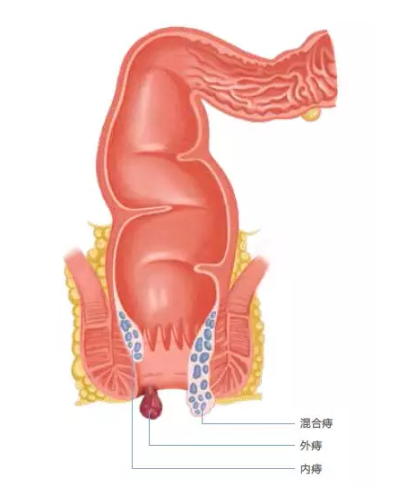 济南肛泰肛肠医院：滴血的“菊花"，出现便血怎么办？