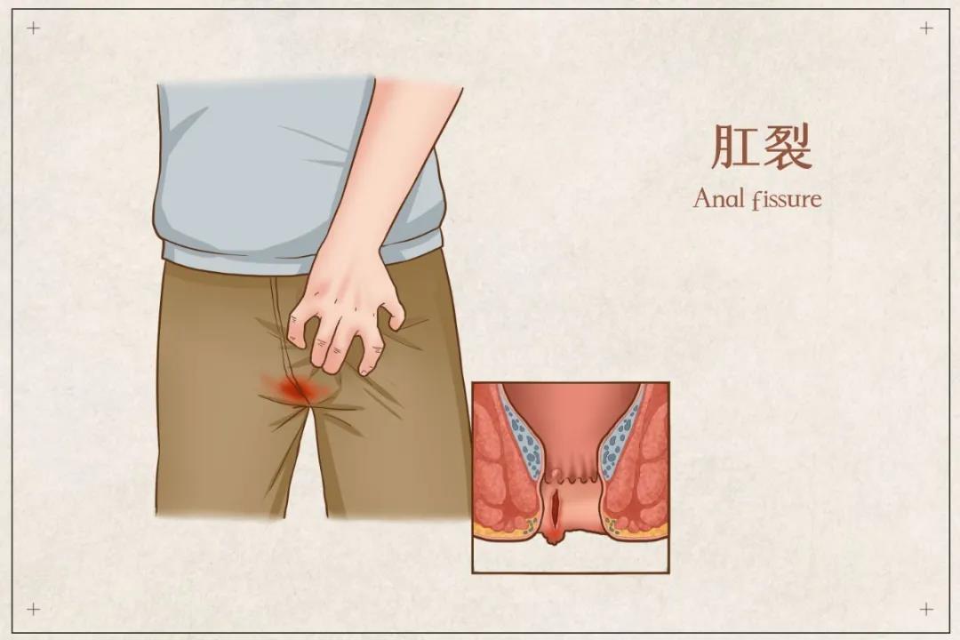 济南肛泰肛肠医院：肛裂不及时治疗会有这些后果！
