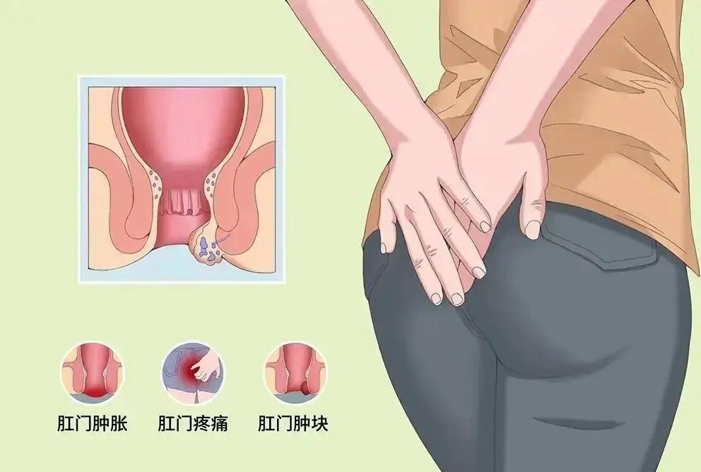 济南肛泰肛肠医院：比痔疮还可怕、还尴尬的肛肠病--肛瘘