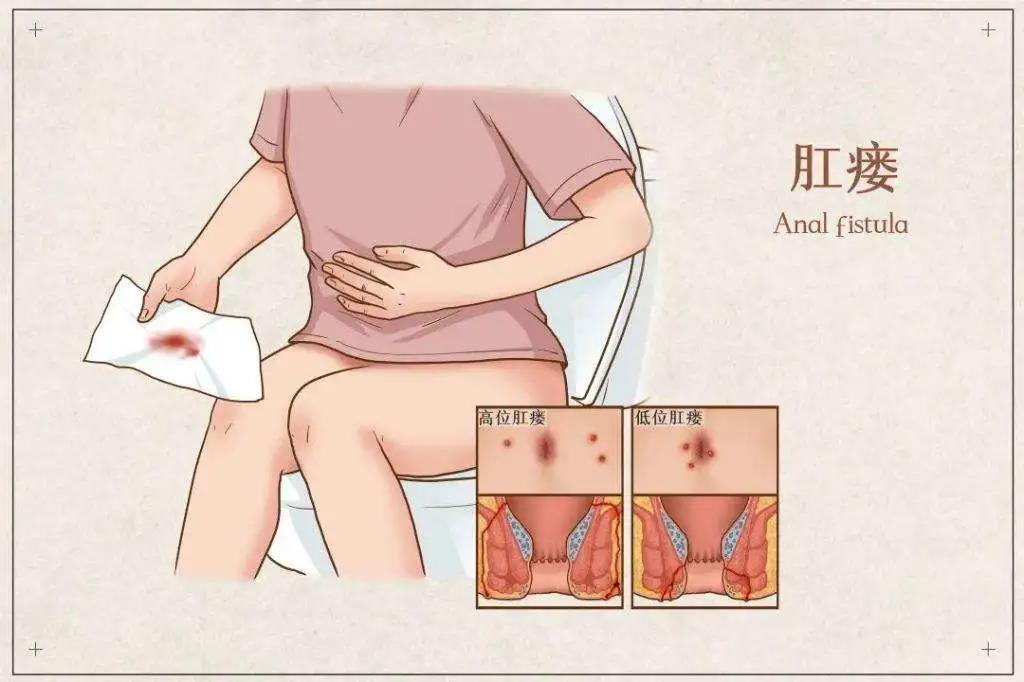 济南肛泰肛肠医院：肛瘘是怎么回事?不管不顾可不行！