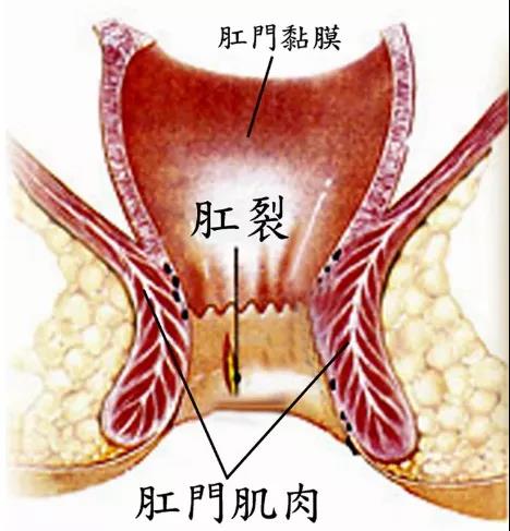 济南肛泰肛肠医院：关于肛裂，怎样做才能有效预防呢？