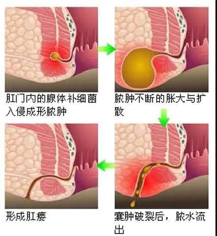 济南肛泰肛肠医院：肛瘘的形成阶段有哪几个？