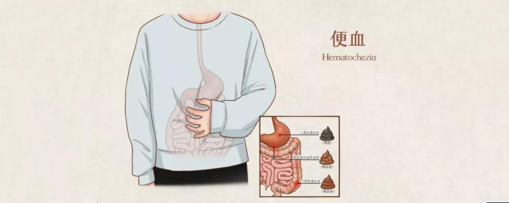 济南肛泰肛肠医院：大便出血就是痔疮吗？