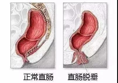 济南肛泰肛肠医院：脱肛不治疗行不行？