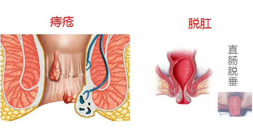 济南肛泰肛肠医院：“脱肛”！希望你不会有这种体验