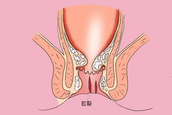 济南肛泰肛肠医院：肛裂一直不好，反反复复怎么办？