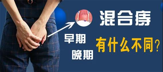 济南肛泰肛肠医院：混合痔早期和晚期有什么不同？