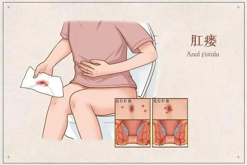 济南肛泰肛肠医院：肛瘘的前期症状有哪些？危害有什么？