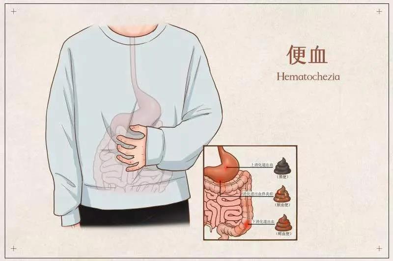 济南肛泰肛肠医院：大便带血需要做哪些检查？